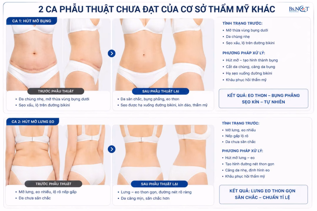 Phân tích tổn thương mô sau hút mỡ hỏng